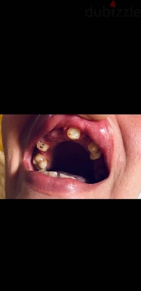 تركيبات الاسنان في جلستين بخصم40‎%‎ تبداء من(250)للسن او الطربوش 1