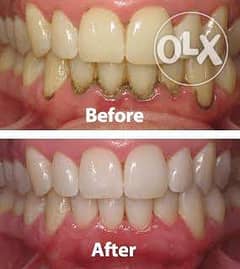 تنظيف و تلميع وإزالة جير الاسنان ١٥٠ فقط وكشف مجاني 0
