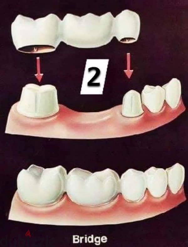 حشو عصب وحشو عادي وطقم اسنان وتركيب اسنان وخلع اسنان 1