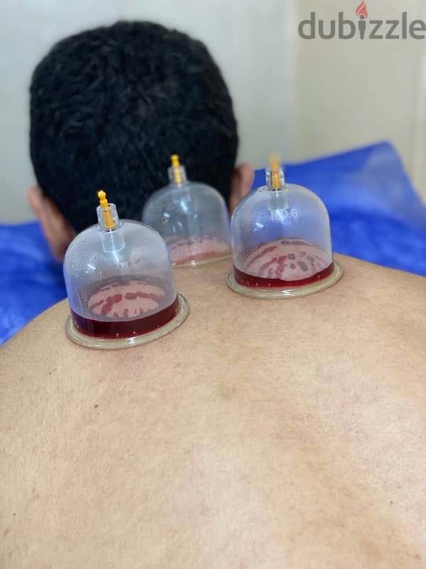 جلسات علاج طبيعي - حجامه - ابر صينيه 0