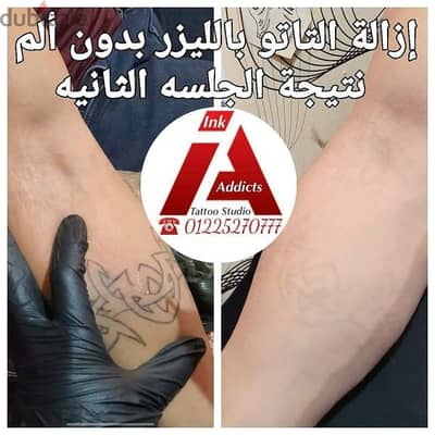 إزالة التاتو و المايكروبلدينج بالليزر بدون ألم