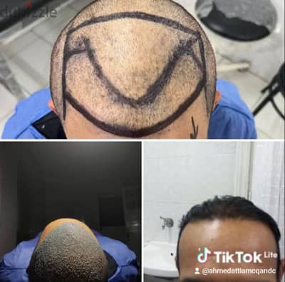 أقل تكلفة زراعة الشعر فى مصر  افضل اسعار