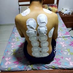 Cupping 0