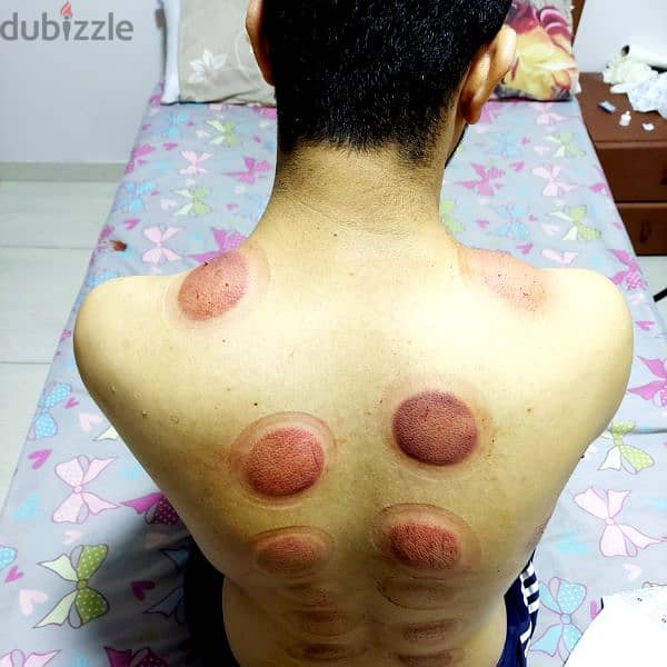 Cupping 2
