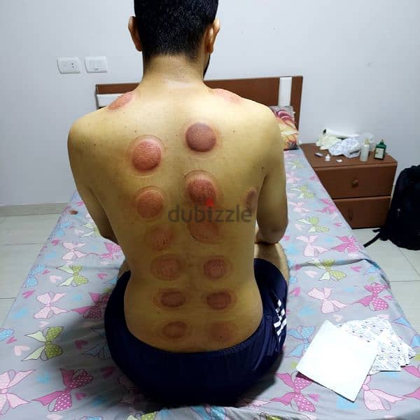 Cupping 3