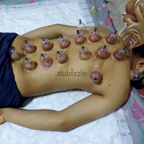 Cupping 5